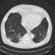 Hypersensitivity angiitis, intraalveolar hemorrhage, HRCT: CT - Computed tomography